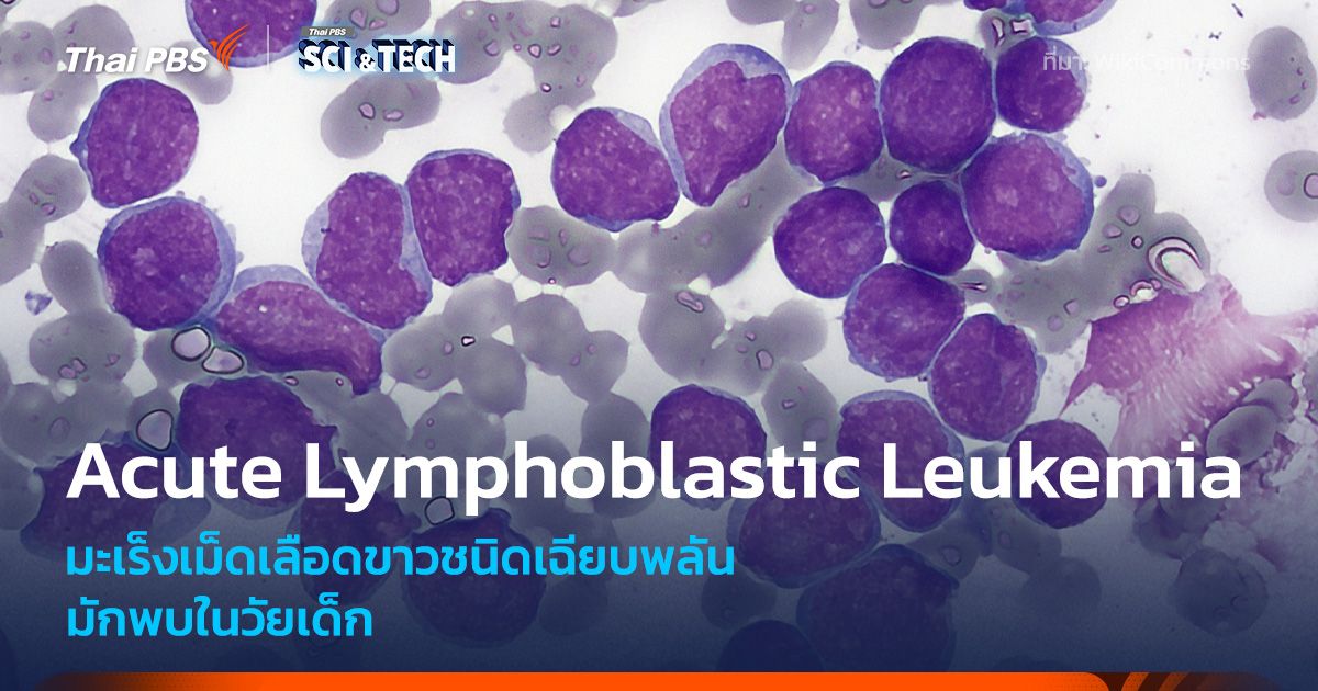 รู้จัก ALL มะเร็งเม็ดเลือดขาวเฉียบพลันในเด็ก