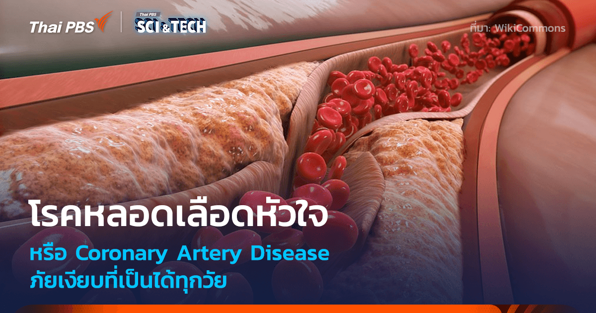 “โรคหลอดเลือดหัวใจ” (Coronary Artery Disease) ภัยเงียบที่เป็นได้ทุกวัย