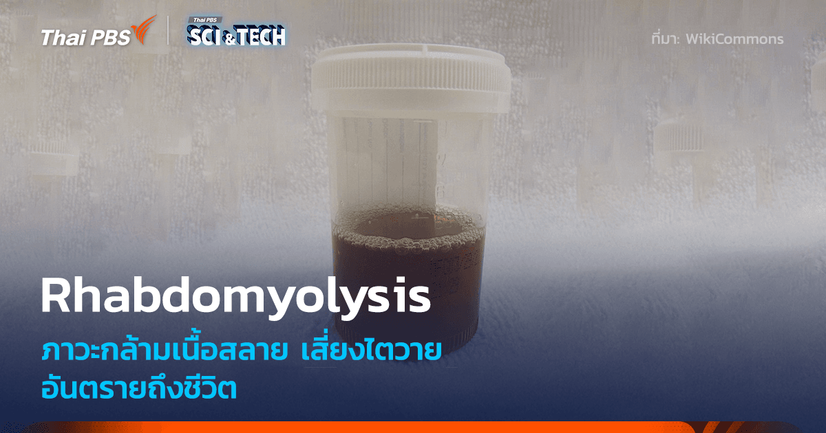ภาวะกล้ามเนื้อลายสลายตัว หรือ Rhabdomyolysis เสี่ยงไตวาย อันตรายถึงชีวิต