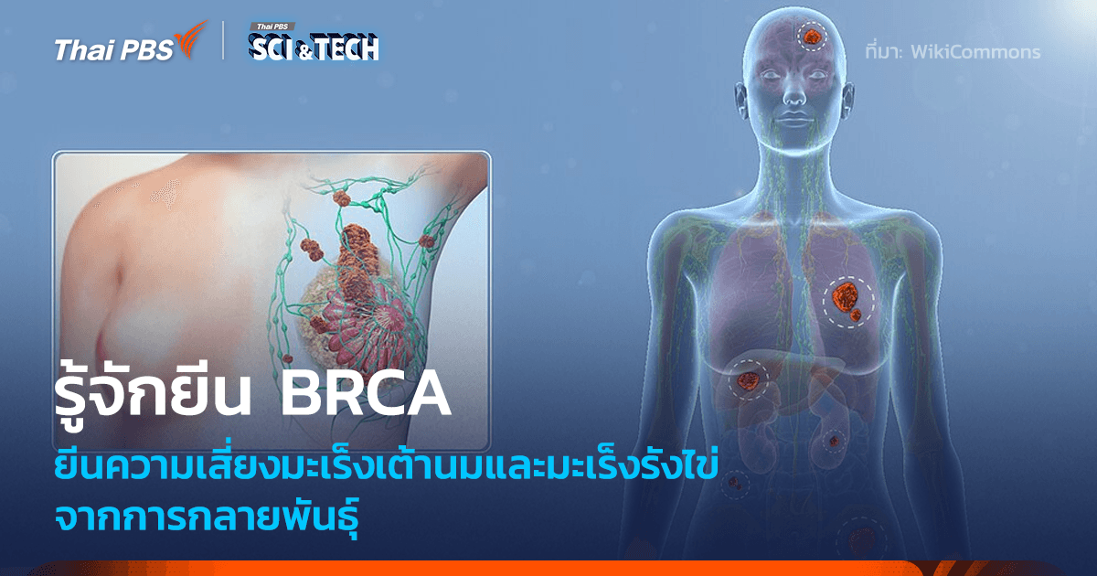 รู้จัก BRCA ยีนบ่งชี้มะเร็งเต้านมและมะเร็งรังไข่