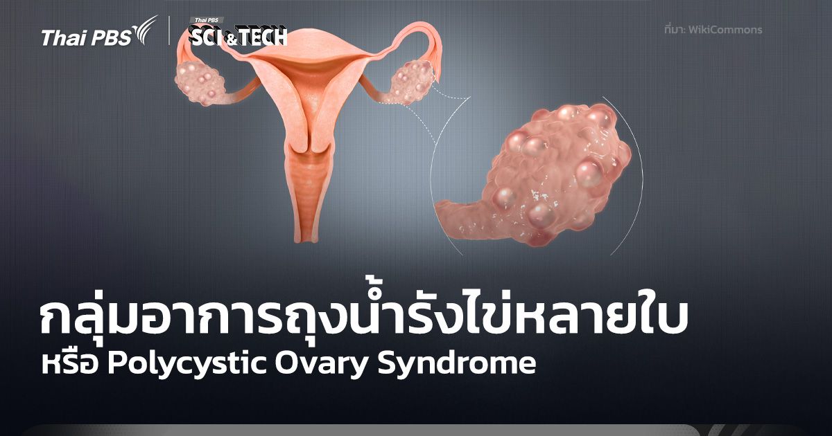 รู้จักกลุ่มอาการถุงน้ำรังไข่หลายใบหรือ Polycystic Ovary Syndrome