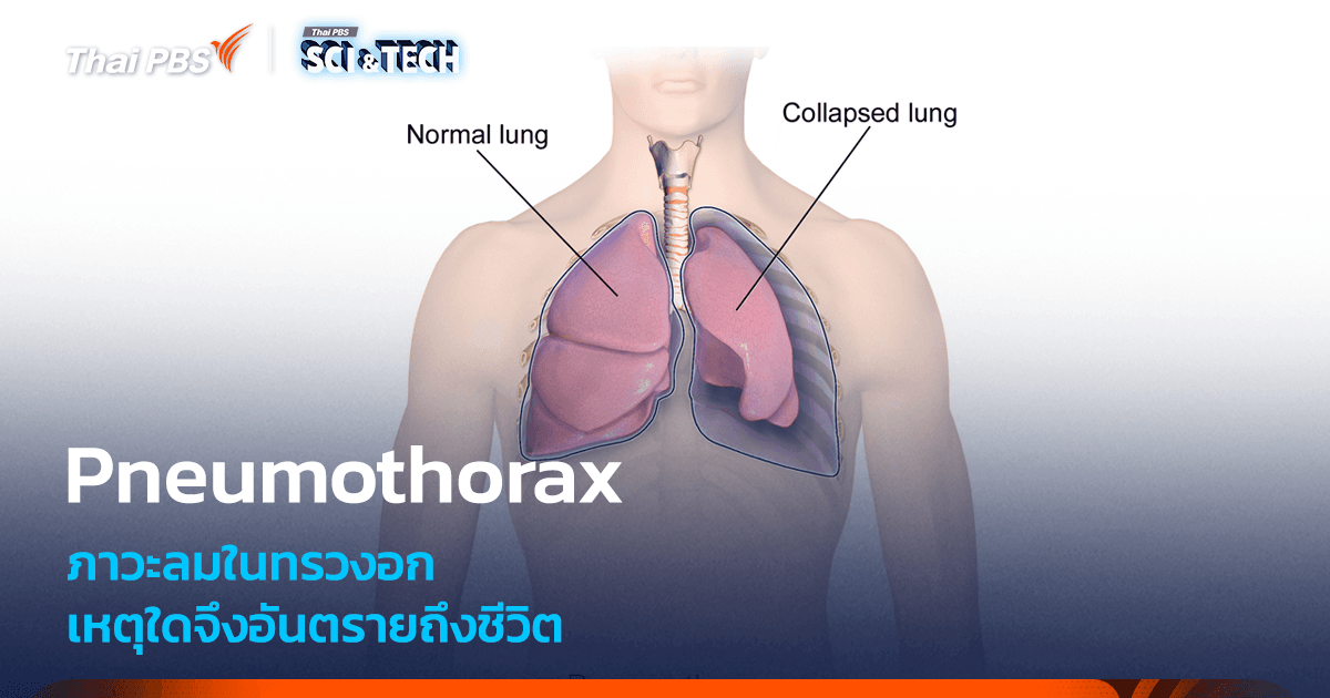 รู้จัก Pneumothorax ภาวะลมในทรวงอก เหตุใดจึงอันตรายถึงชีวิต