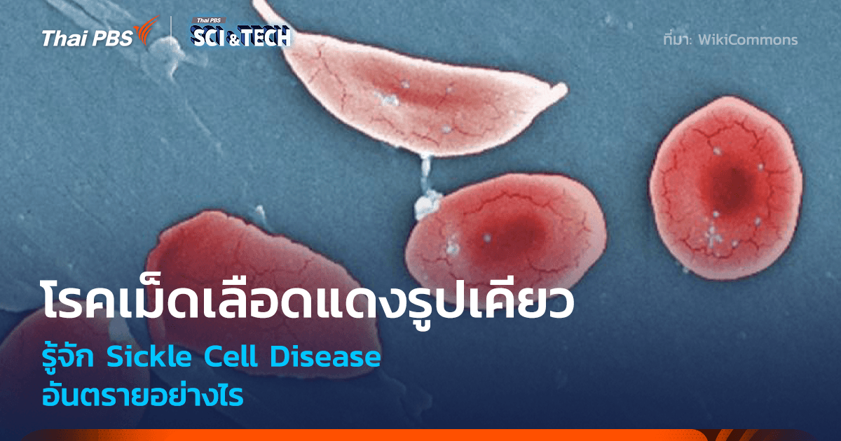 โรคเม็ดเลือดแดงรูปเคียว รู้จัก Sickle Cell Disease