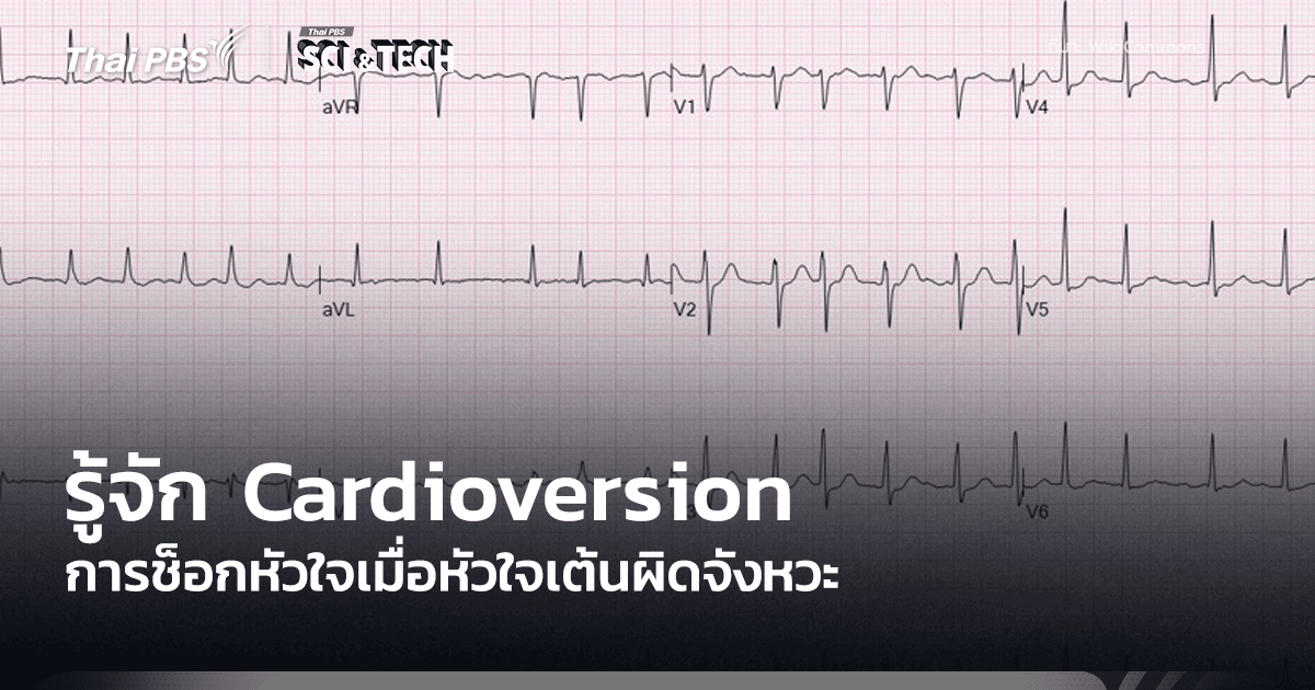 รู้จัก Cardioversion การช็อกหัวใจเมื่อหัวใจเต้นผิดจังหวะ