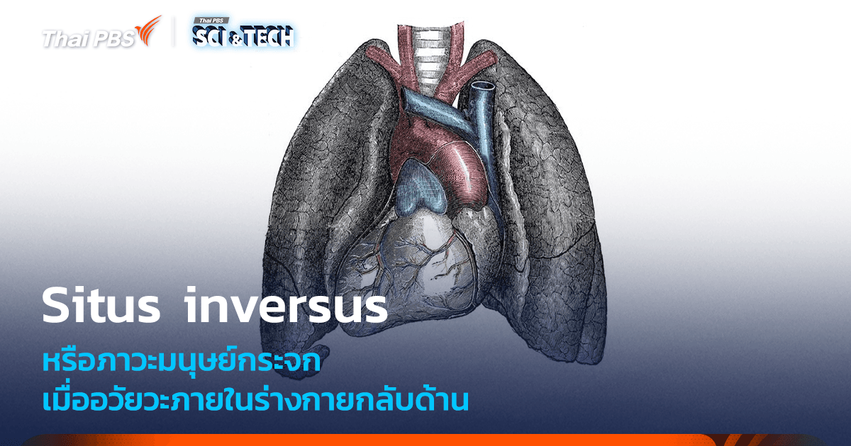 ภาวะอวัยวะภายในกลับด้าน รู้จัก Situs Inversus