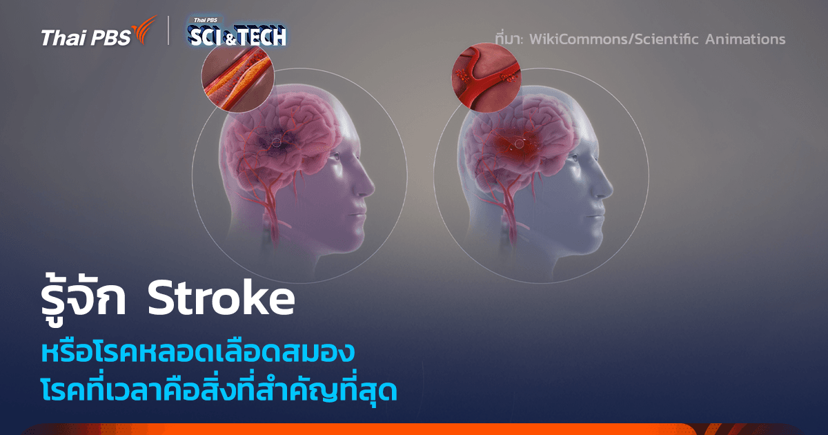 รู้จัก Stroke โรคที่เวลาคือสิ่งที่สำคัญที่สุด