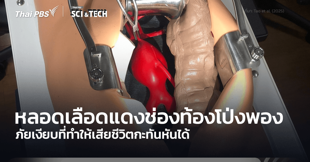 ภาวะหลอดเลือดแดงช่องท้องโป่งพอง ภัยเงียบทำให้เสียชีวิตกะทันหันได้