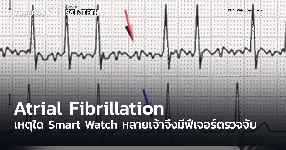 Atrial Fibrillation ภาวะหัวใจห้องบนสั่นพลิ้ว เหตุใดสมาร์ตวอตช์จำนวนมากจึงมีฟีเจอร์ตรวจจับภาวะนี้