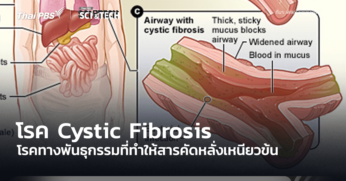 รู้จักโรค Cystic Fibrosis ทำให้เสมหะและสารคัดหลั่งเหนียวข้นผิดปกติเป็นโรคปอดเรื้อรัง