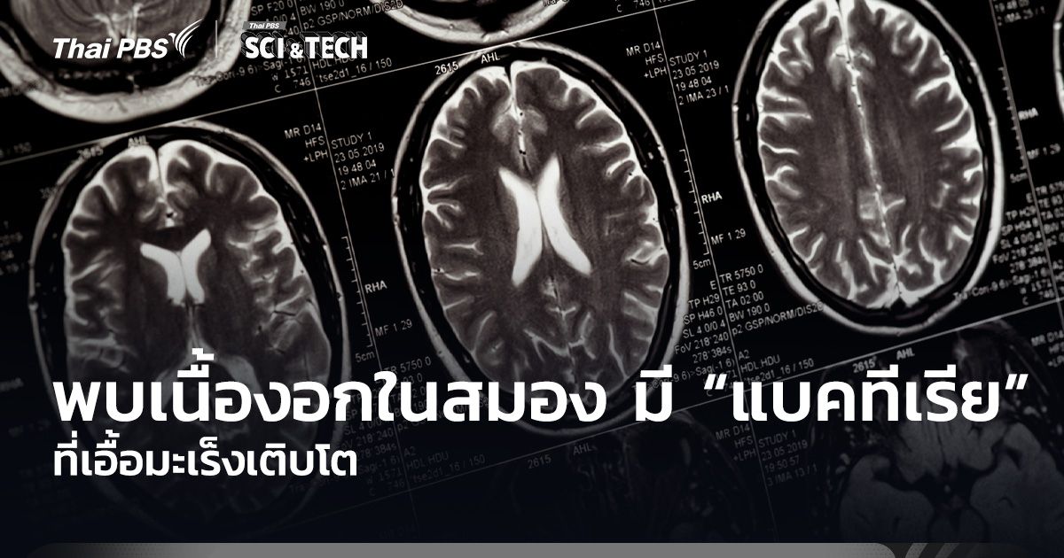 นักวิจัยพบเนื้องอกในสมอง มี “แบคทีเรีย” ที่เอื้อมะเร็งเติบโต 