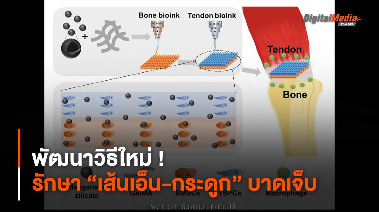 พัฒนาวิธีใหม่ ! รักษา “เส้นเอ็น-กระดูก” บาดเจ็บ
