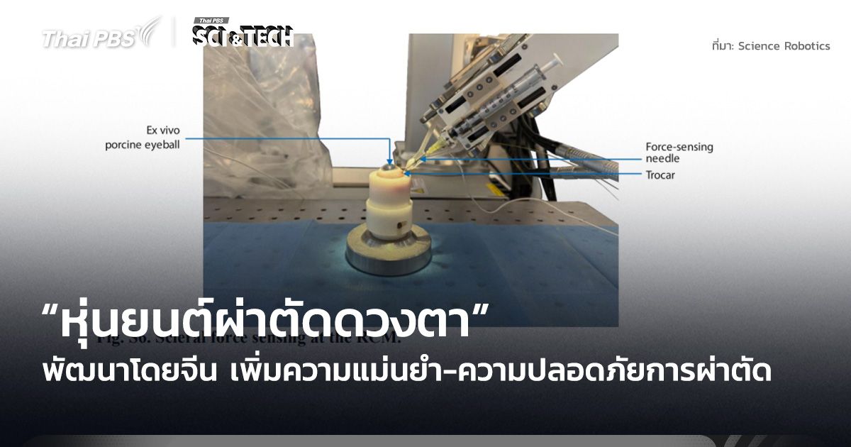 “หุ่นยนต์ผ่าตัดดวงตา” พัฒนาโดยจีน เพิ่มความแม่นยำ-ความปลอดภัยการผ่าตัด