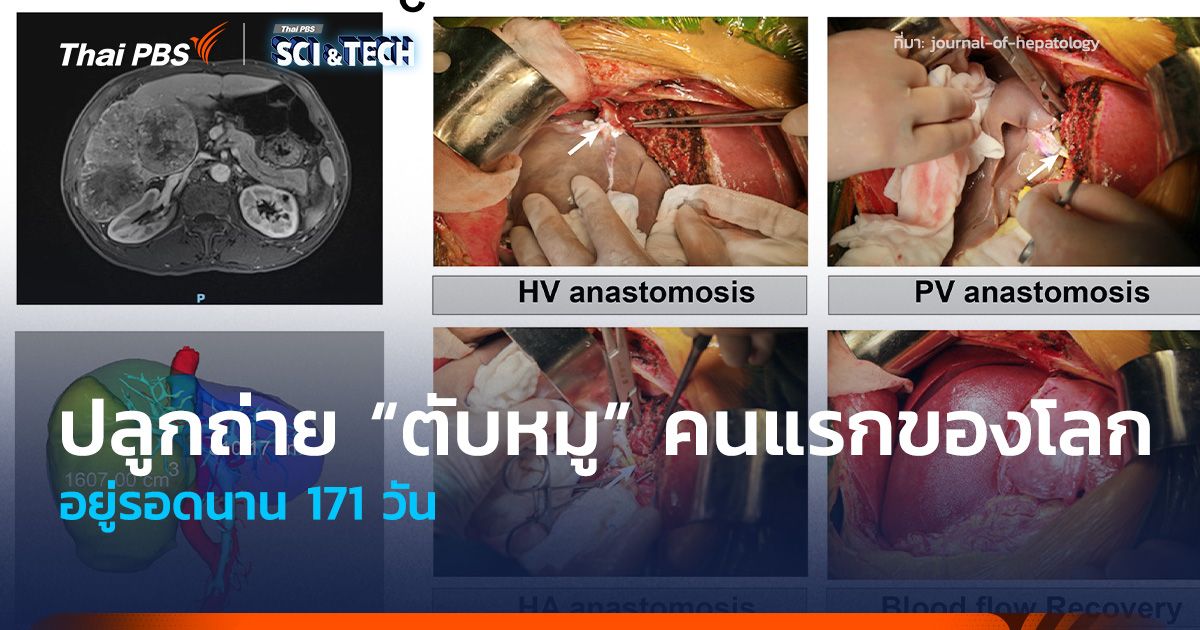 ผู้ป่วยรับปลูกถ่าย “ตับหมู” คนแรกของโลก อยู่รอดนาน 171 วัน