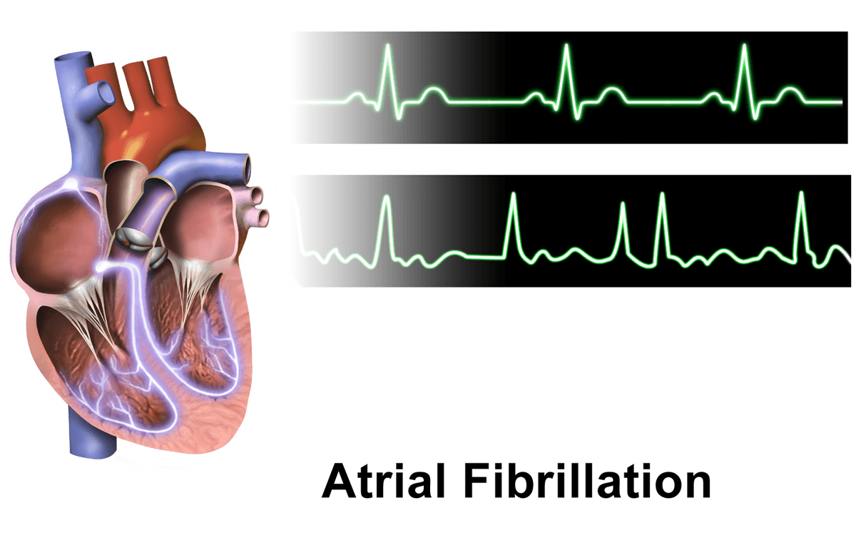 Atrial Fibrillation เกิดขึ้นเมื่อหัวใจห้องบนสั่นพลิ้วแทนที่จะเต้นเป็นจังหวะ ขณะเดียวกันก็สามารถสูบฉีดเลือดได้ปกติ