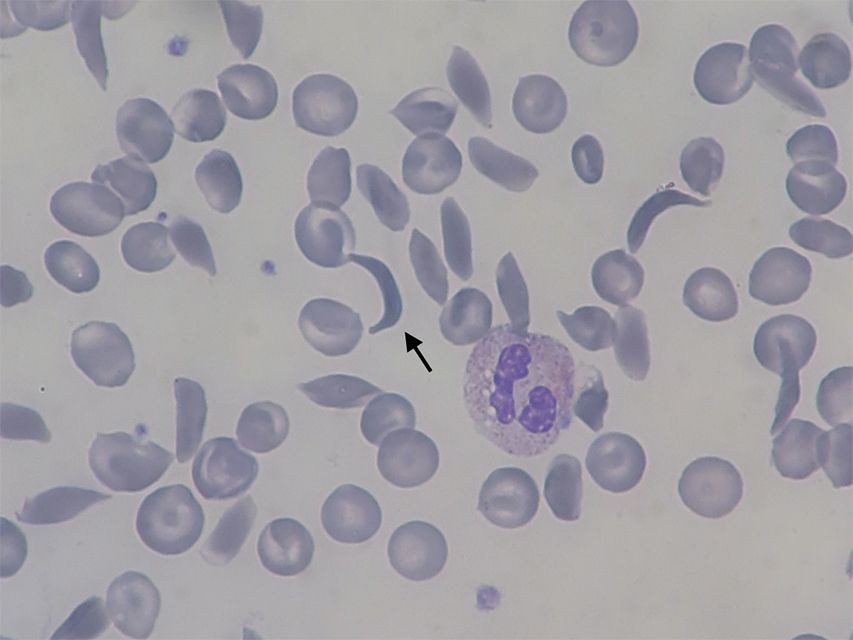 Blood Smear ของผู้ป่วย SCD แสดงให้เห็นเม็ดเลือดแดงรูปเคียว 