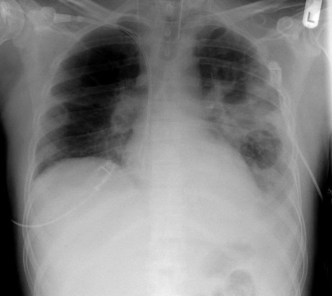 ปอดเป็นหนึ่งในอวัยวะที่ได้รับผลกระทบมากที่สุดจากโรค CF เนื่องจากสารคัดหลั่งในปอดมักจะข้นและเหนียวจนทำให้เกิดปัญหาด้านการอักเสบและอุดตันของปอด