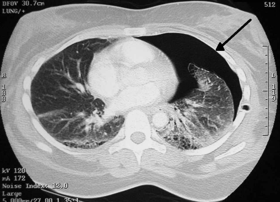 ภาพ CT Scan แสดงลมในทรวงอกและภาวะปอดแฟบ
