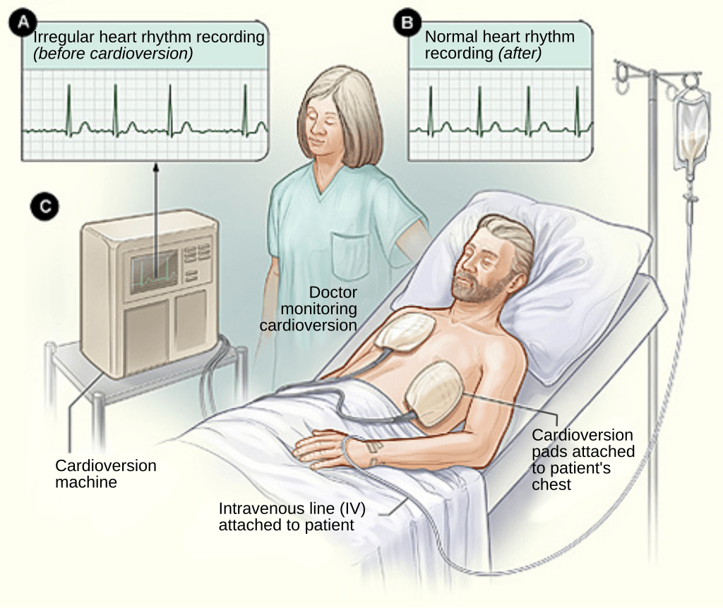 การทำ Cardioversion ด้วยเครื่อง Defribrillator ซึ่งอาศัยการติดแผ่น Electrode ไว้ที่หน้าอกของผู้ป่วยหรือหลังของผู้ป่วยร่วมกับหน้าอก