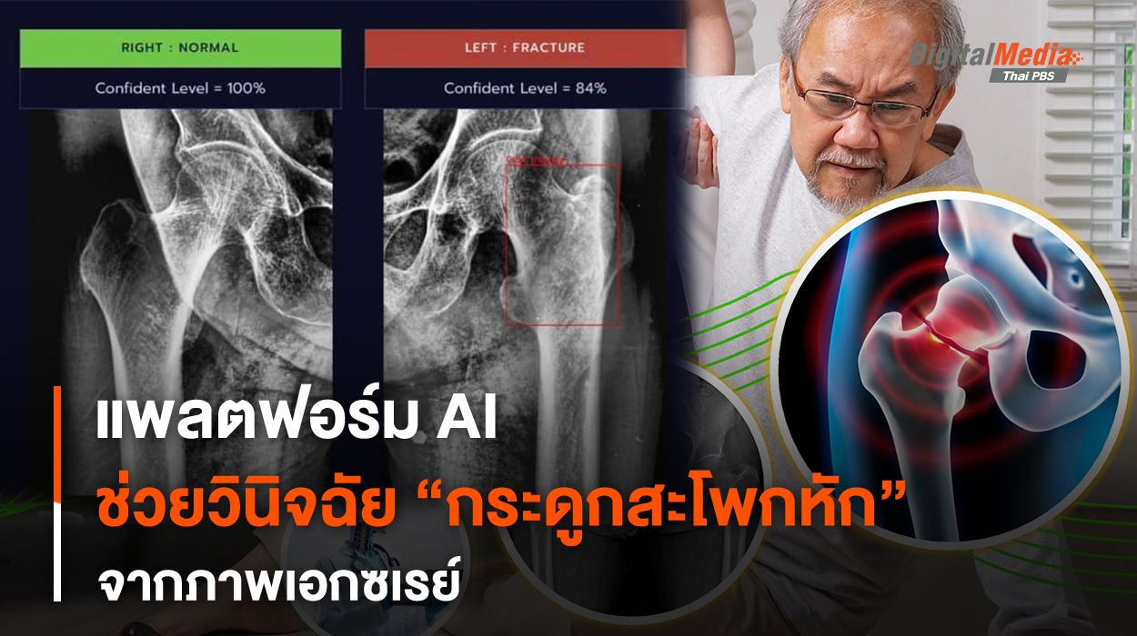 นวัตกรรม AICEDA BoneX ใช้ AI ช่วยวินิจฉัยกระดูกสะโพกหักจากภาพเอกซเรย์