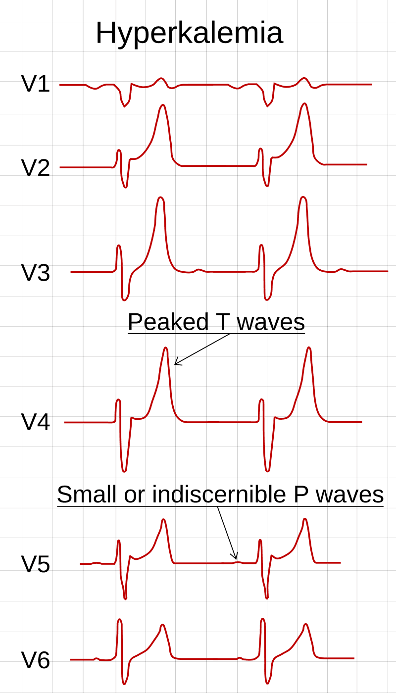 ECG ในผู้ที่มีภาวะโพแทสเซียมสูง Hyperkalemia