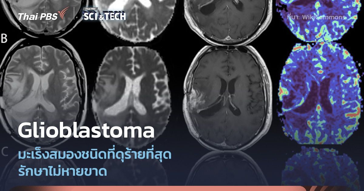 รู้จัก Glioblastoma มะเร็งสมองที่ดุที่สุดและรักษาไม่หายขาด