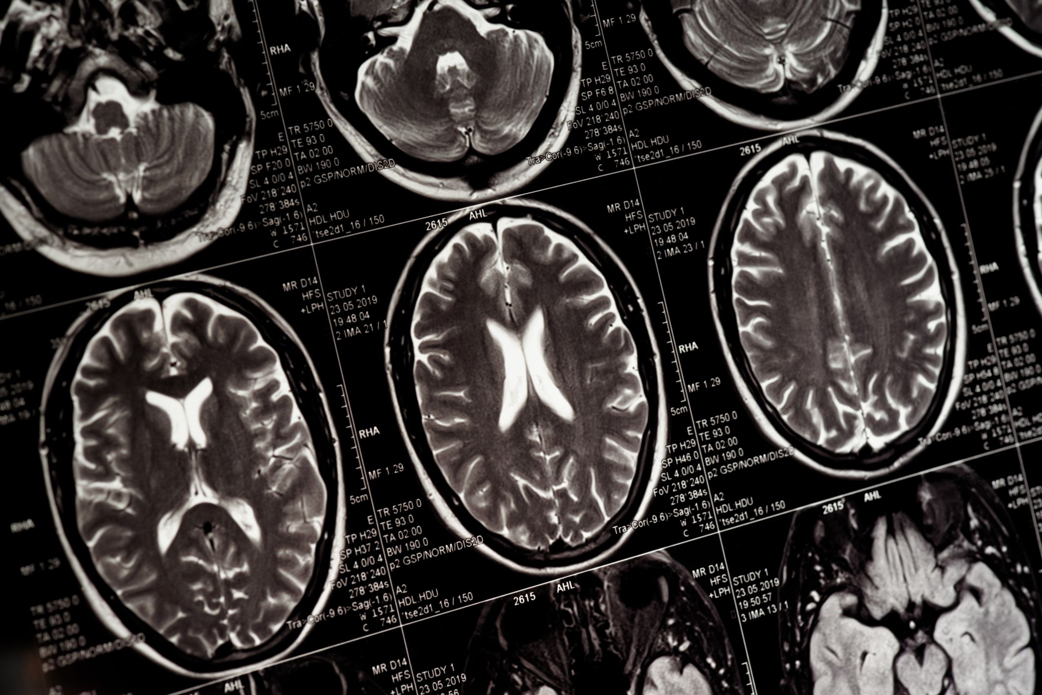 Magnetic Resonance Imaging หรือ MRI คือ เครื่องมือในการตรวจหาความผิดปกติของร่างกาย โดยใช้เครื่องสนามแม่เหล็ก และคลื่นความถี่วิทยุ สร้างภาพที่มีความละเอียดสูง