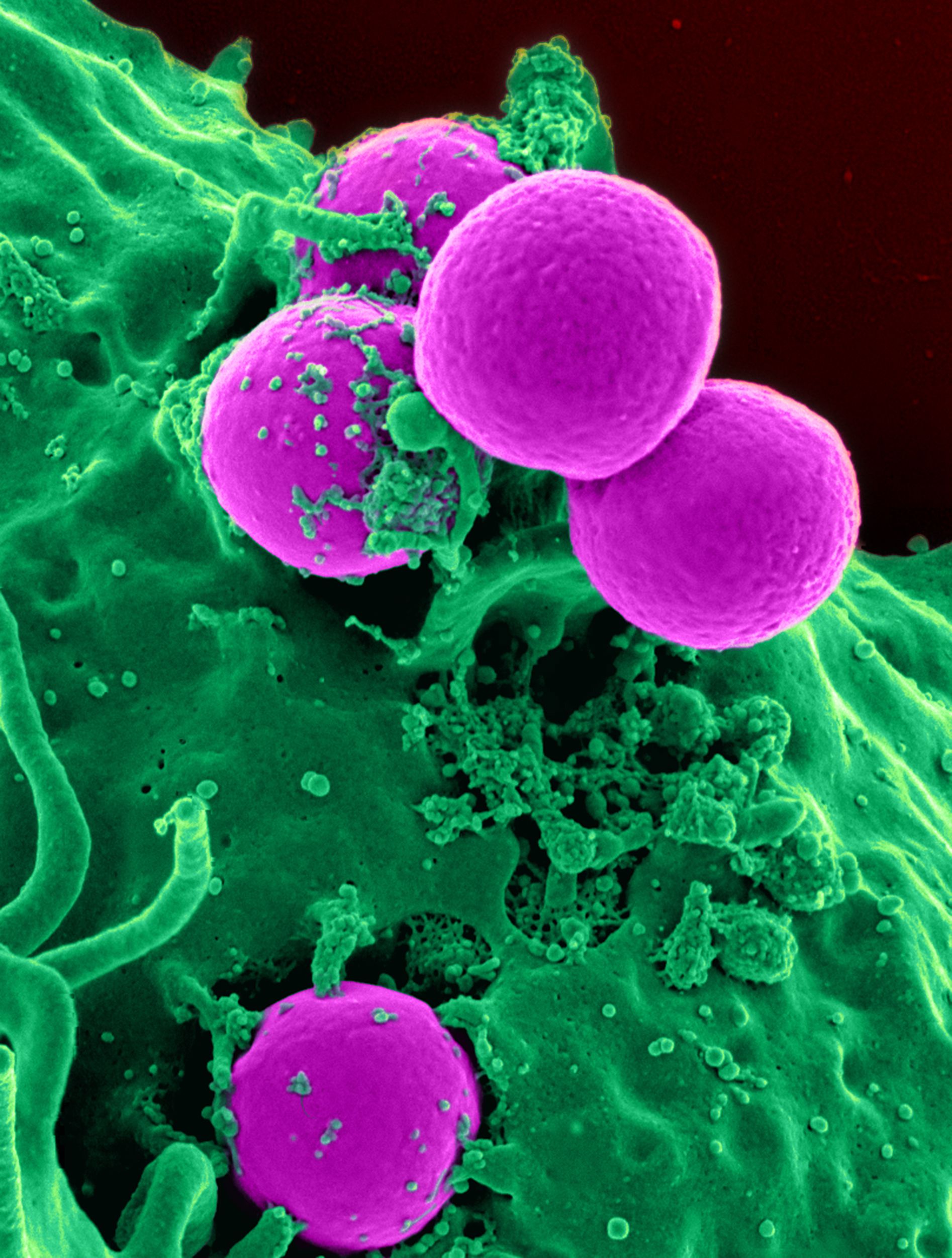 เชื้อดื้อยาปฏิชีวนะหลายชนิด MRSA