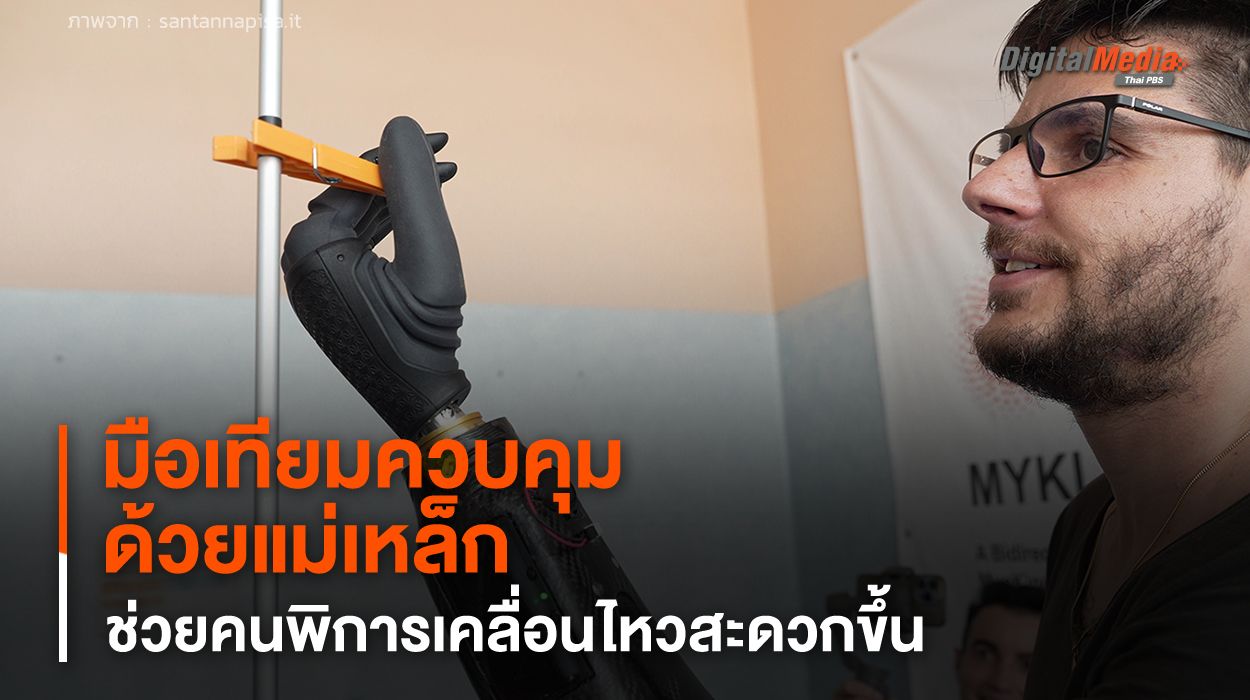 มือเทียมควบคุมด้วยแม่เหล็ก ช่วยคนพิการเคลื่อนไหวสะดวกขึ้น