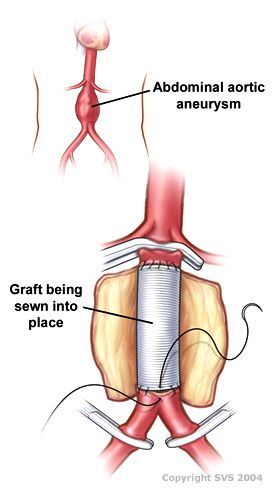 การผ่าตัดแบบ Open Aortic Repair เพื่อทดแทนหลอดเลือดส่วนที่โป่งพองด้วย Graft