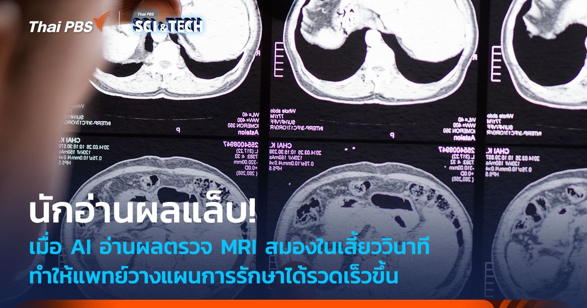 เมื่อ AI อ่านผลตรวจ MRI สมองในเสี้ยววินาที ช่วยวางแผนการรักษาได้เร็วขึ้น