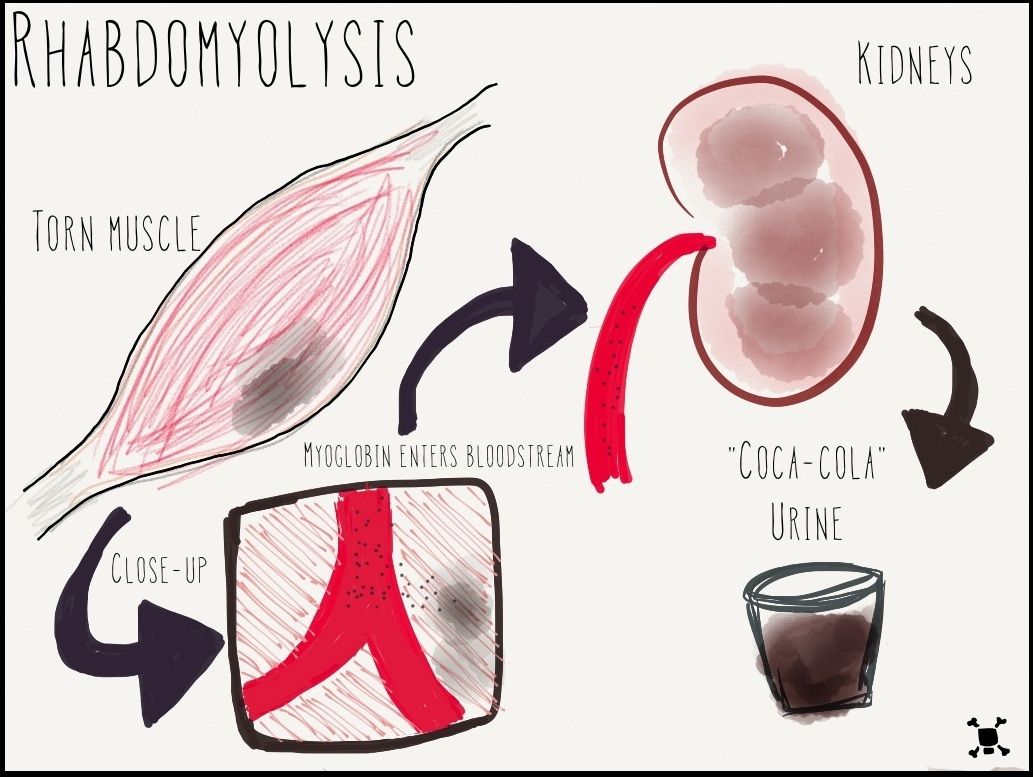 ภาวะ Rhabdomyolysis หรือภาวะกล้ามเนื้อสลายเฉียบพลัน ทำให้เกิดภาวะปัสสาวะสีโค้ก