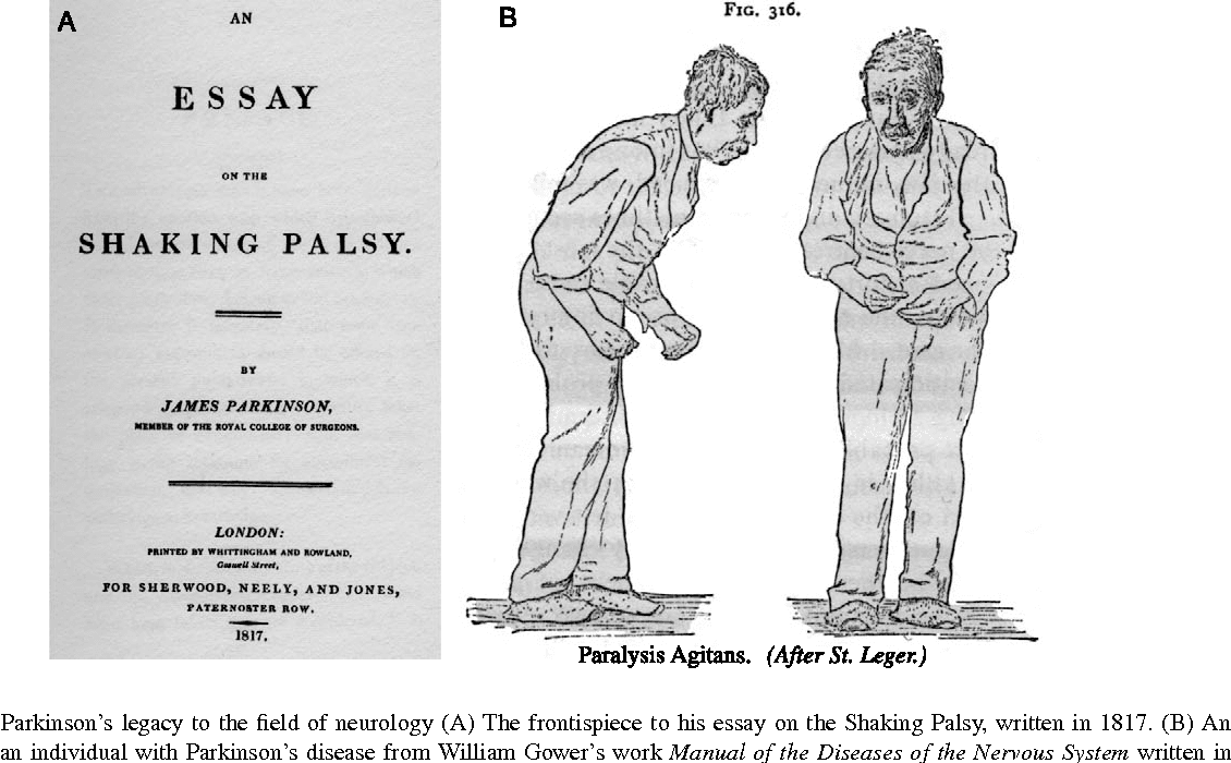 บทความเรื่อง Shaking Palsy ของเจมส์ พาร์กินสัน