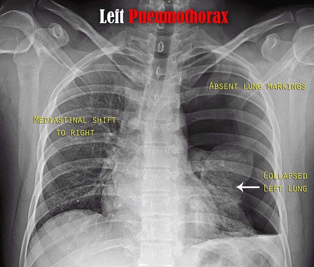 ภาพ X-ray แสดง Pneumothorax ในปอดด้านซ้าย ทำให้เกิดภาวะปอดแฟบขึ้น