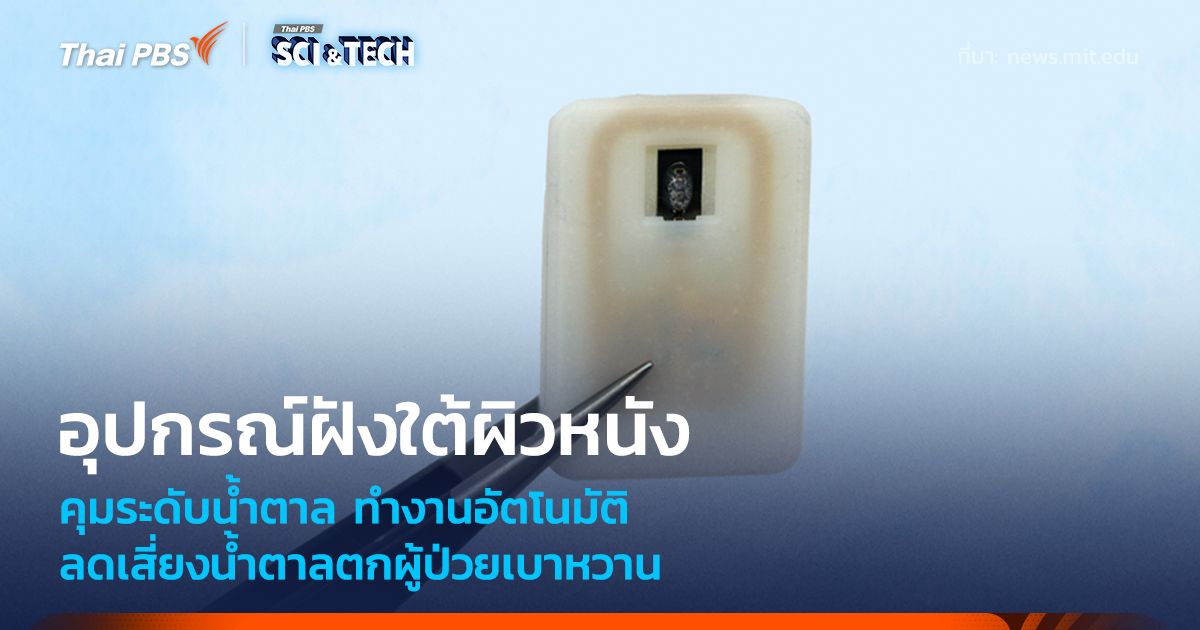 อุปกรณ์ฝังใต้ผิวหนัง คุมระดับน้ำตาลอัตโนมัติ ลดเสี่ยงน้ำตาลตกผู้ป่วยเบาหวานชนิดที่ 1