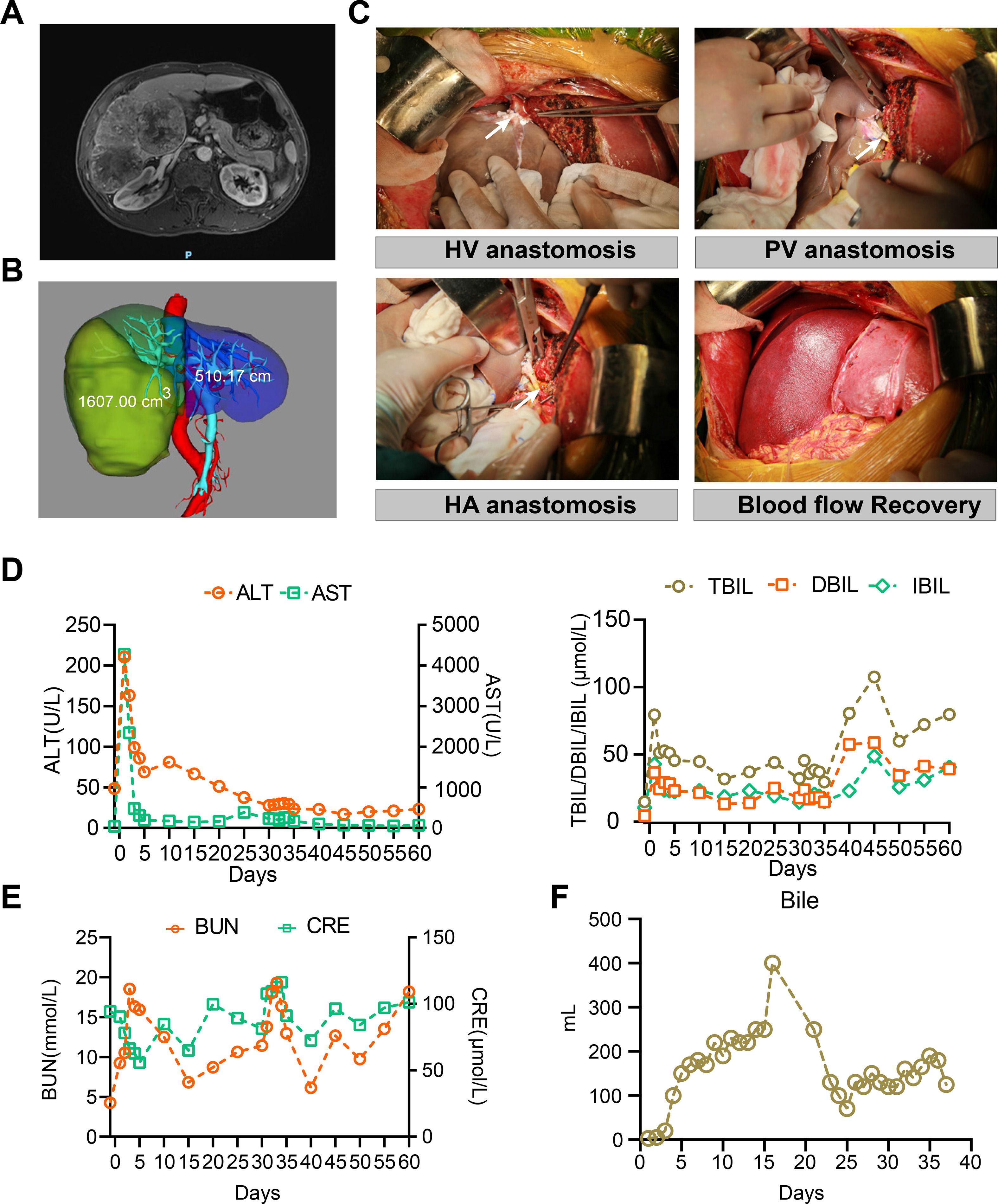 การผ่าตัดผู้ป่วยรับปลูกถ่าย “ตับหมู” คนแรกของโลก ภาพจาก journal-of-hepatology