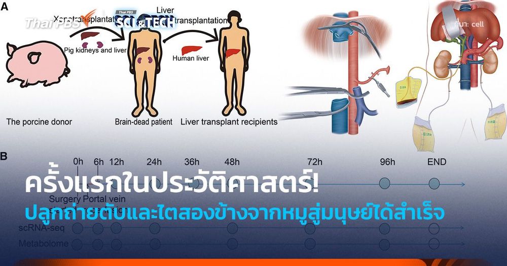 ครั้งแรกในประวัติศาสตร์! ปลูกถ่ายตับและไตสองข้างจากหมูสู่มนุษย์ได้สำเร็จ