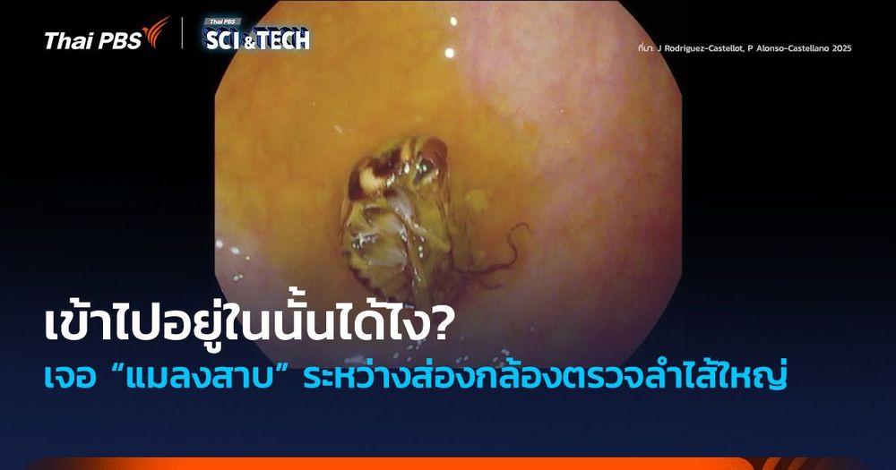 เข้าไปอยู่ในนั้นได้ไง? เจอ “แมลงสาบ” ระหว่างส่องกล้องตรวจลำไส้ใหญ่
