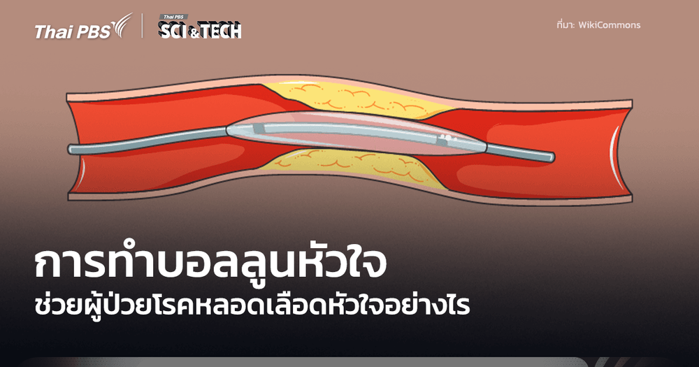 Percutaneous Coronary Intervention การทำบอลลูนหัวใจ มีหลักการทำงานอย่างไร
