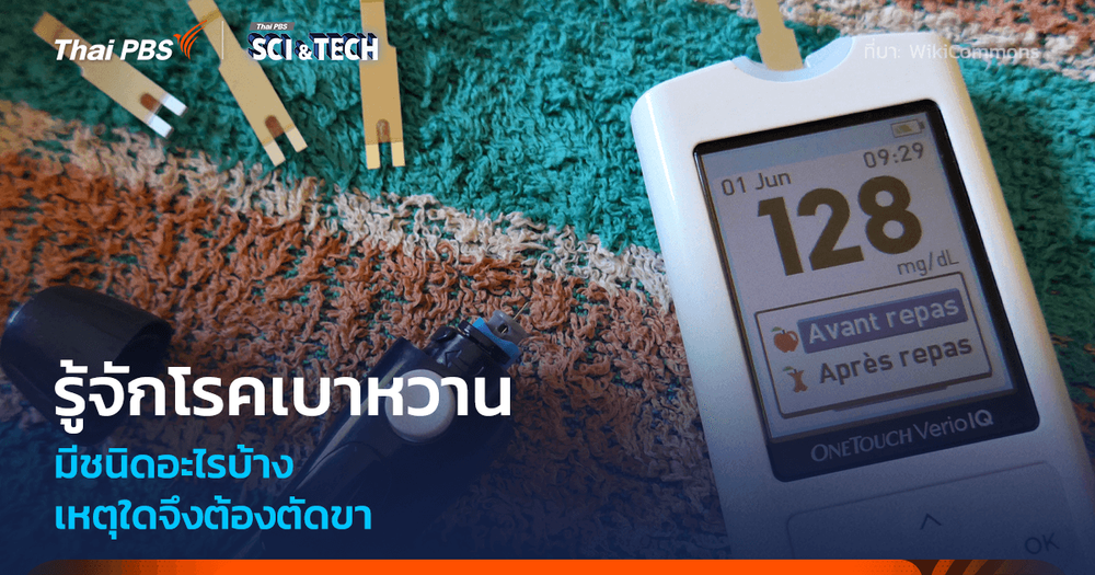 รู้จัก “โรคเบาหวาน” เหตุใด ? จึงต้องตัดขา