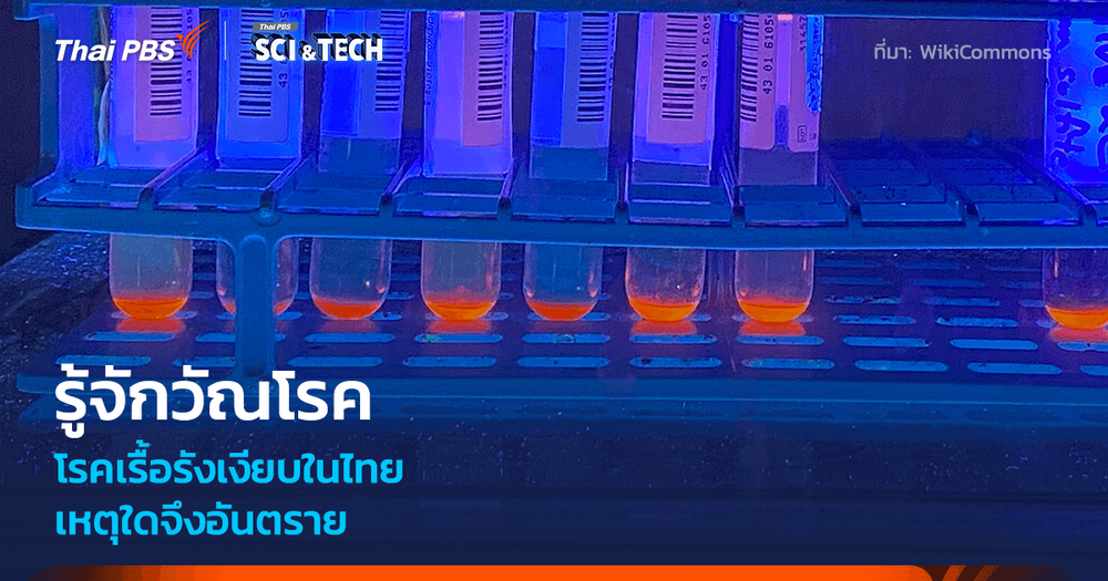 รู้จัก “วัณโรค” โรคร้ายใกล้ตัวที่ยังไม่หมดไปจากสังคมไทย