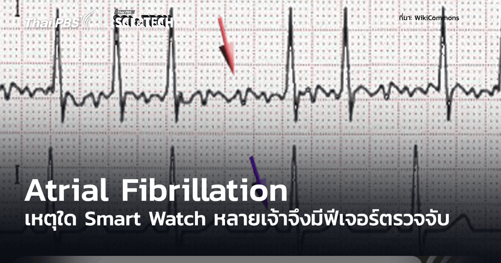 Atrial Fibrillation ภาวะหัวใจห้องบนสั่นพลิ้ว เหตุใดสมาร์ตวอตช์จำนวนมากจึงมีฟีเจอร์ตรวจจับภาวะนี้