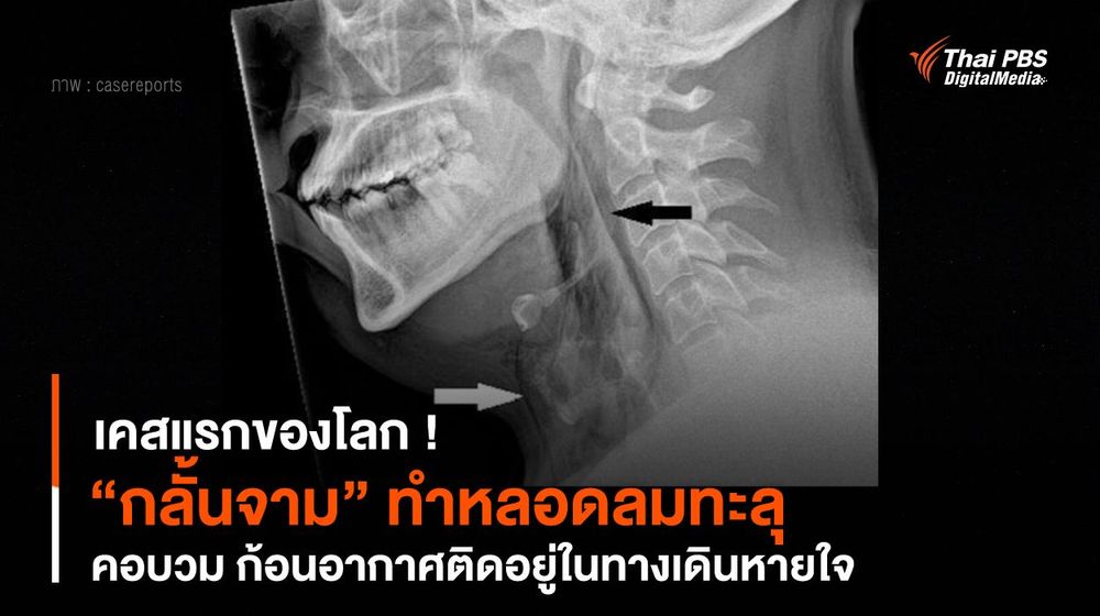เคสแรกของโลก ! “กลั้นจาม” ทำหลอดลมทะลุ-คอบวม 