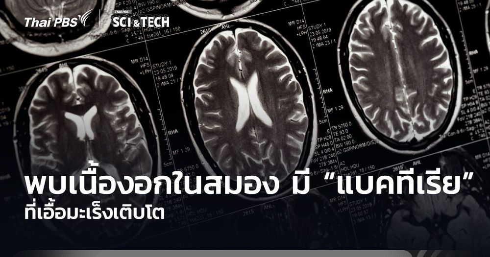 นักวิจัยพบเนื้องอกในสมอง มี “แบคทีเรีย” ที่เอื้อมะเร็งเติบโต 