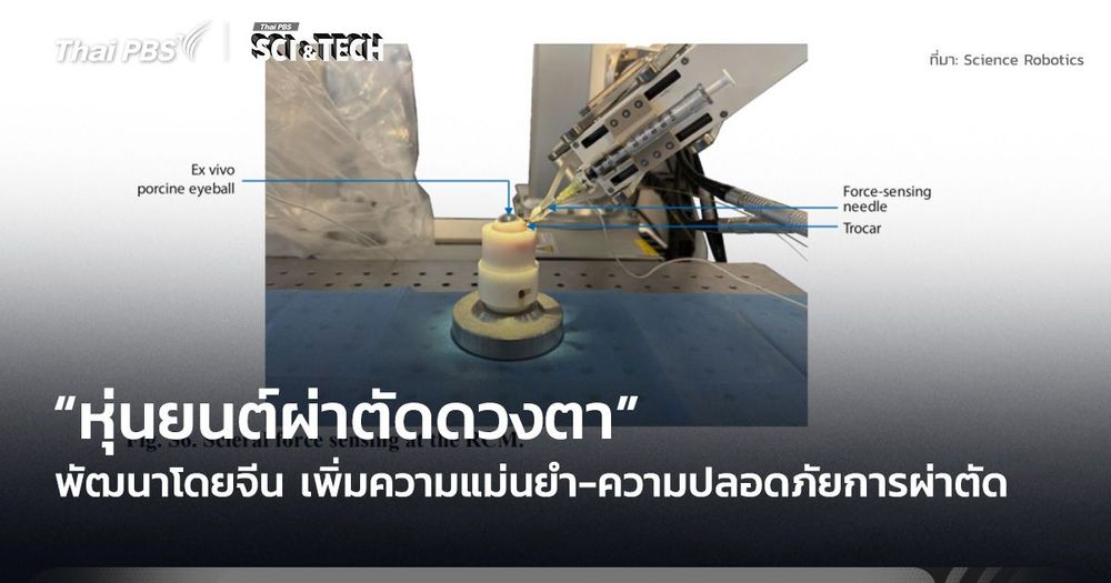 “หุ่นยนต์ผ่าตัดดวงตา” พัฒนาโดยจีน เพิ่มความแม่นยำ-ความปลอดภัยการผ่าตัด