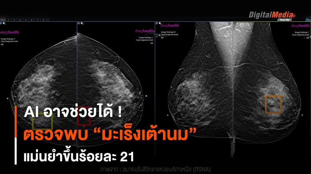 AI อาจช่วยได้ ! ตรวจ “มะเร็งเต้านม” แม่นยำขึ้นร้อยละ 21