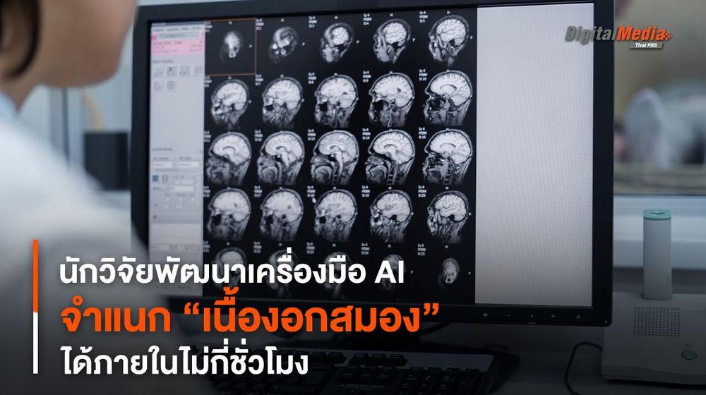 นักวิจัยพัฒนาเครื่องมือ AI จำแนก “เนื้องอกสมอง” ได้ภายในไม่กี่ชั่วโมง