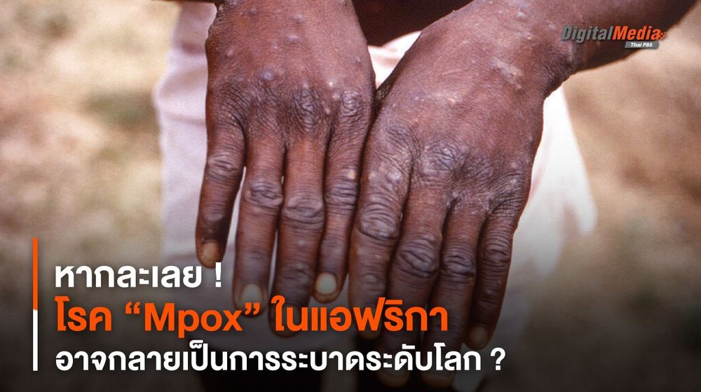 หากละเลย “Mpox” ในแอฟริกา อาจกลายเป็นการระบาดระดับโลก ?