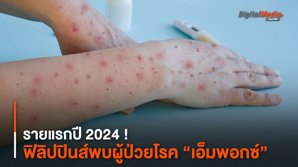 รายแรกปี 2024 ! ฟิลิปปินส์พบผู้ป่วยโรค “เอ็มพอกซ์”