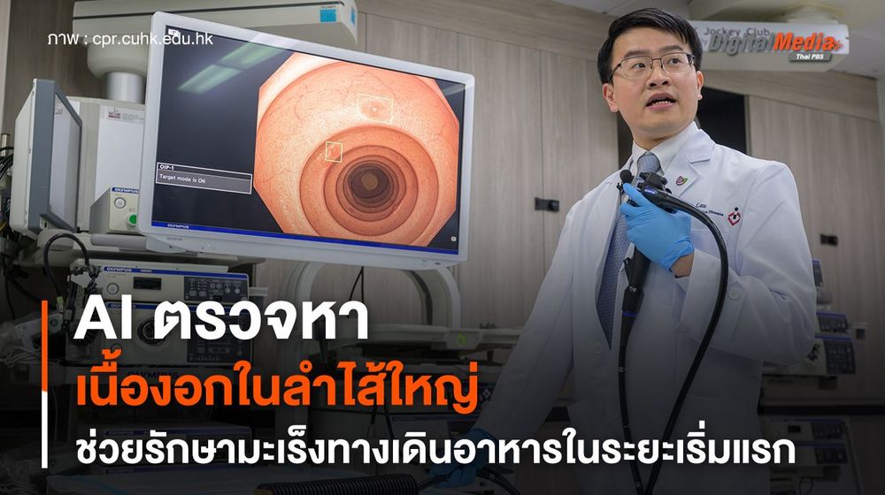 AI ตรวจหาเนื้องอกในลำไส้ใหญ่ ช่วยรักษามะเร็งทางเดินอาหารในระยะเริ่มแรก