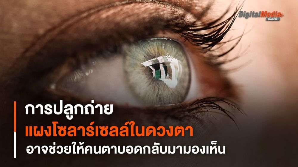 การปลูกถ่าย "แผงโซลาร์เซลล์" ในดวงตา อาจช่วยให้คนตาบอดกลับมามองเห็น